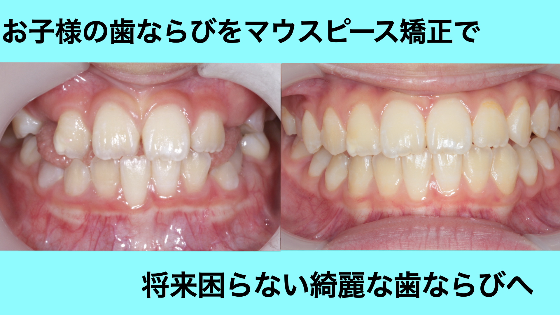 永久歯がガタガタに生えてきてしまった小学生の歯並びをインビザラインで改善した症例