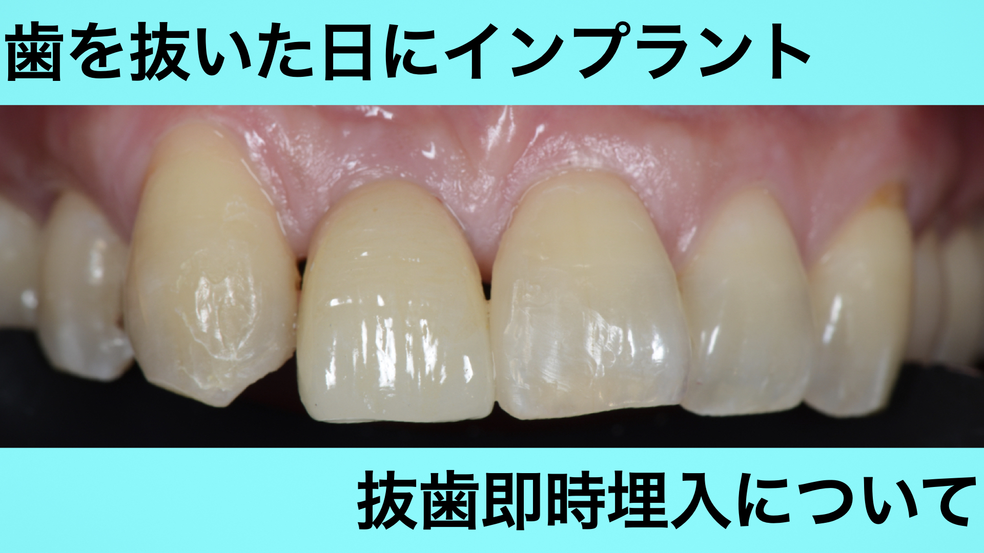 前歯にインプラントを行った症例